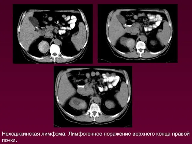 Неходжкинская лимфома. Лимфогенное поражение верхнего конца правой почки.