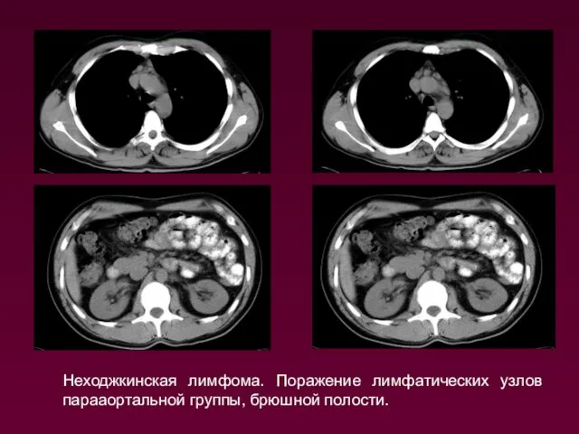 Неходжкинская лимфома. Поражение лимфатических узлов парааортальной группы, брюшной полости.