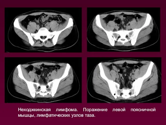 Неходжкинская лимфома. Поражение левой поясничной мышцы, лимфатических узлов таза.