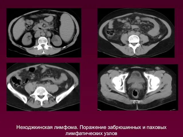Неходжкинская лимфома. Поражение забрюшинных и паховых лимфатических узлов