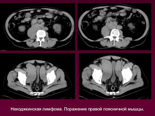 Неходжкинская лимфома. Поражение правой поясничной мышцы.