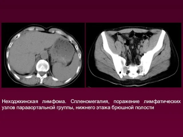 Неходжкинская лимфома. Спленомегалия, поражение лимфатических узлов парааортальной группы, нижнего этажа брюшной полости