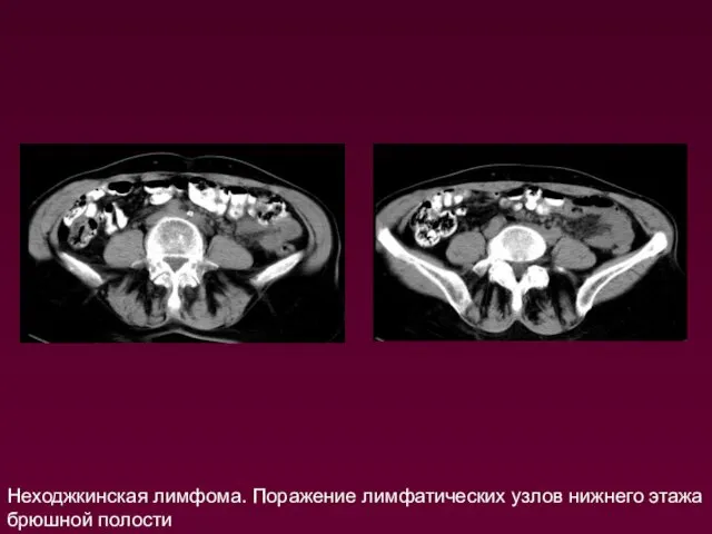 Неходжкинская лимфома. Поражение лимфатических узлов нижнего этажа брюшной полости