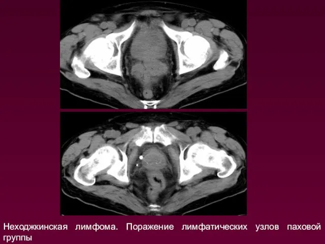 Неходжкинская лимфома. Поражение лимфатических узлов паховой группы