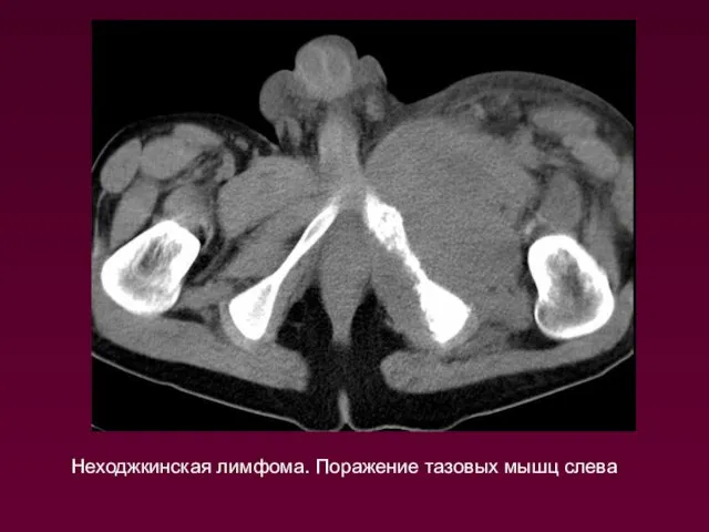 Неходжкинская лимфома. Поражение тазовых мышц слева