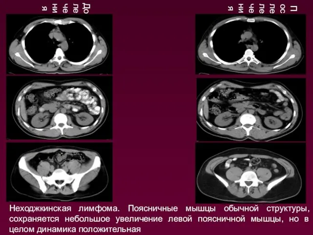 Неходжкинская лимфома. Поясничные мышцы обычной структуры, сохраняется небольшое увеличение левой поясничной