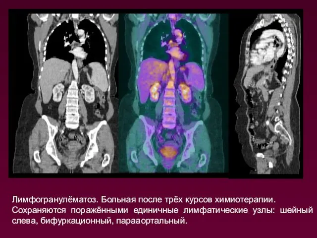 Лимфогранулёматоз. Больная после трёх курсов химиотерапии. Сохраняются поражёнными единичные лимфатические узлы: шейный слева, бифуркационный, парааортальный.