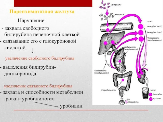 Паренхиматозная желтуха - захвата свободного билирубина печеночной клеткой связывание его с