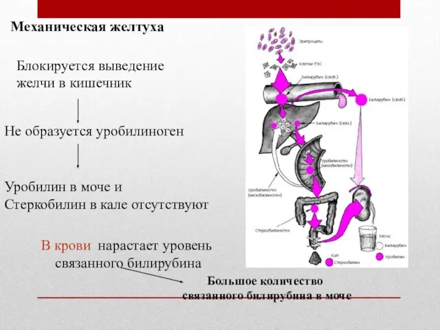 Механическая желтуха Блокируется выведение желчи в кишечник Не образуется уробилиноген Уробилин