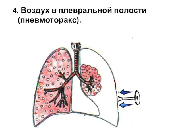 4. Воздух в плевральной полости (пневмоторакс).