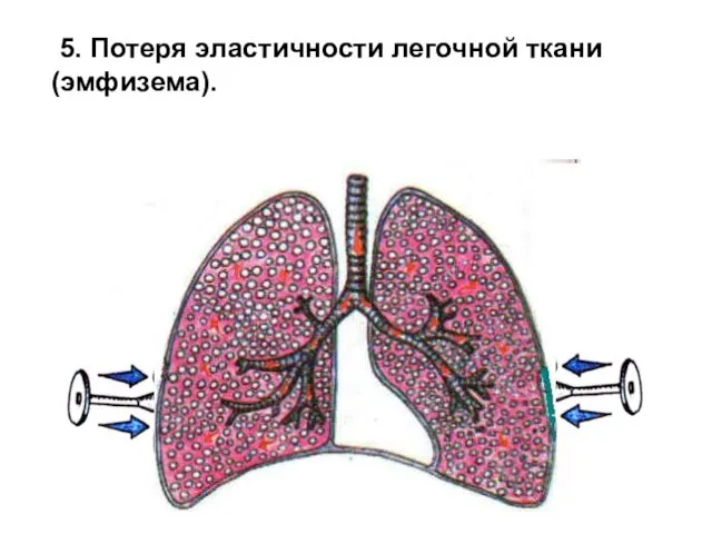 5. Потеря эластичности легочной ткани (эмфизема).