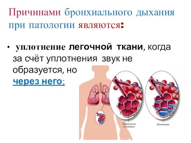 Причинами бронхиального дыхания при патологии являются: уплотнение легочной ткани, когда за