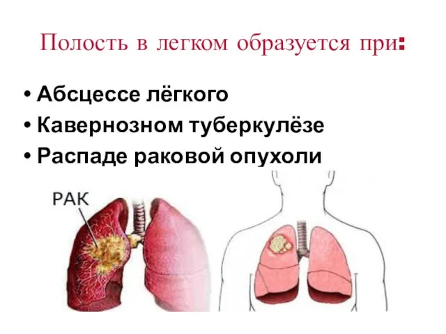 Полость в легком образуется при: Абсцессе лёгкого Кавернозном туберкулёзе Распаде раковой опухоли