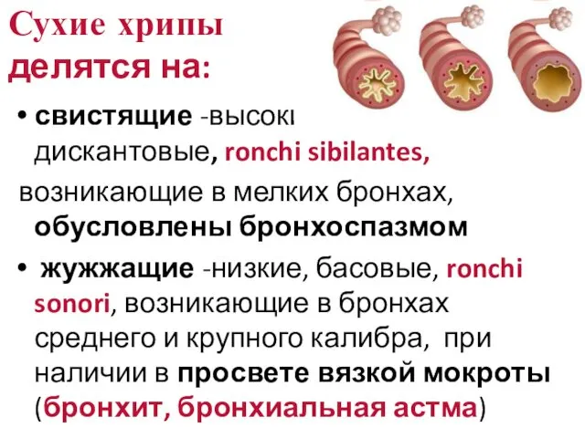 Сухие хрипы делятся на: свистящие -высокие, дискантовые, ronchi sibilantes, возникающие в