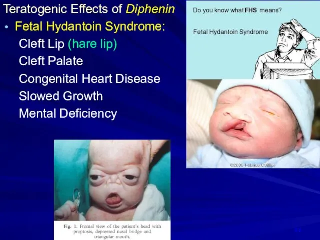 Teratogenic Effects of Diphenin Fetal Hydantoin Syndrome: Cleft Lip (hare lip)