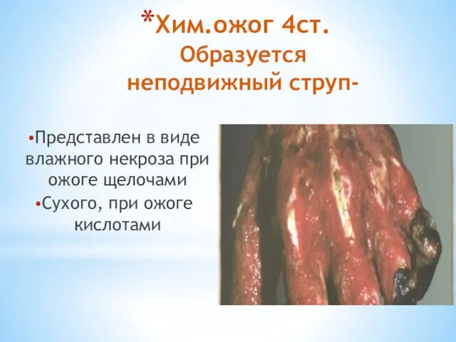 Хим.ожог 4ст. Образуется неподвижный струп- Представлен в виде влажного некроза при