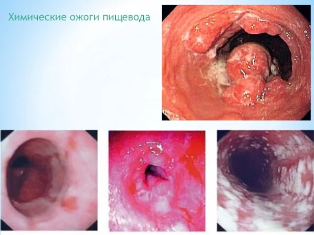 Химические ожоги пищевода