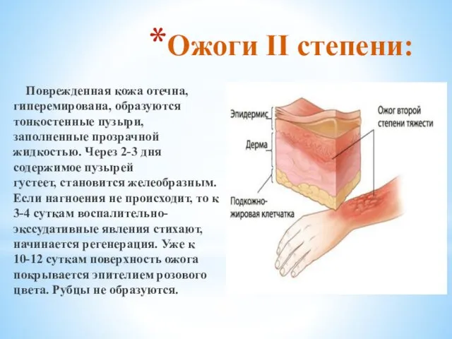 Ожоги II степени: Поврежденная кожа отечна, гиперемирована, образуются тонкостенные пузыри, заполненные