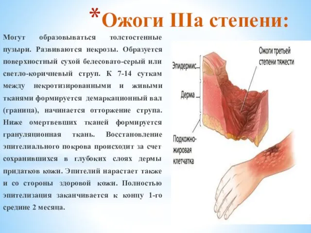 Ожоги IIIа степени: Могут образовываться толстостенные пузыри. Развиваются некрозы. Образуется поверхностный