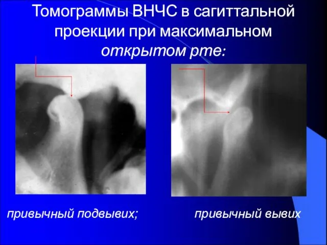 Томограммы ВНЧС в сагиттальной проекции при максимальном открытом рте: привычный подвывих; привычный вывих