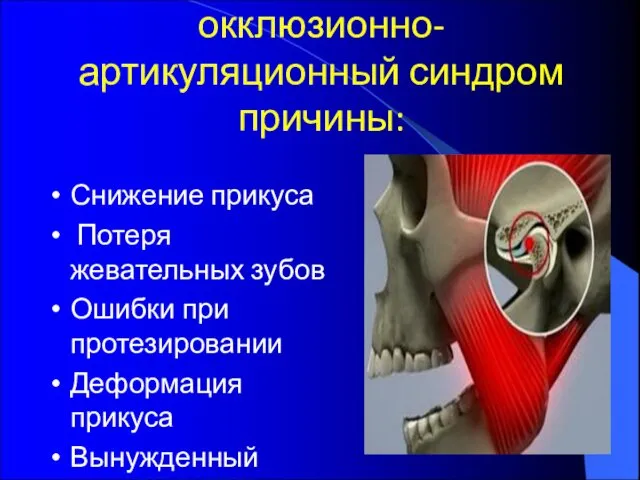 окклюзионно-артикуляционный синдром причины: Снижение прикуса Потеря жевательных зубов Ошибки при протезировании Деформация прикуса Вынужденный прикус