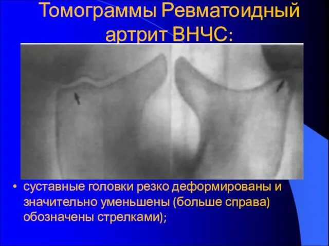 Томограммы Ревматоидный артрит ВНЧС: суставные головки резко деформированы и значительно уменьшены (больше справа) обозначены стрелками);