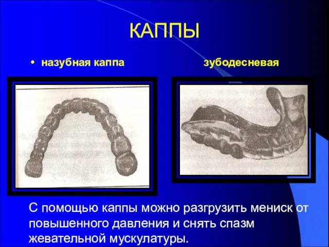 КАППЫ назубная каппа зубодесневая С помощью каппы можно разгрузить мениск от