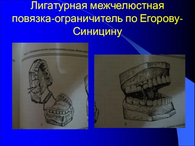 Лигатурная межчелюстная повязка-ограничитель по Егорову-Синицину