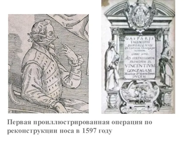 Первая проиллюстрированная операция по реконструкции носа в 1597 году