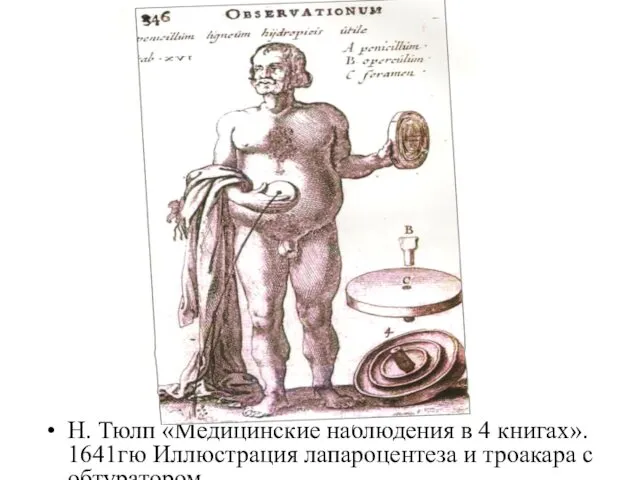 Н. Тюлп «Медицинские наблюдения в 4 книгах». 1641гю Иллюстрация лапароцентеза и троакара с обтуратором