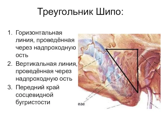 Треугольник Шипо: Горизонтальная линия, проведённая через надпроходную ость Вертикальная линия, проведённая