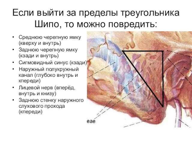 Если выйти за пределы треугольника Шипо, то можно повредить: Среднюю черепную