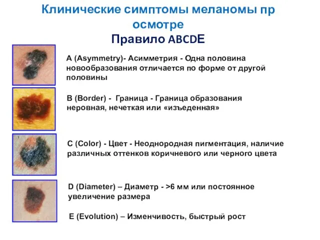 Клинические симптомы меланомы пр осмотре Правило ABCDЕ А (Asymmetry)- Асимметрия -