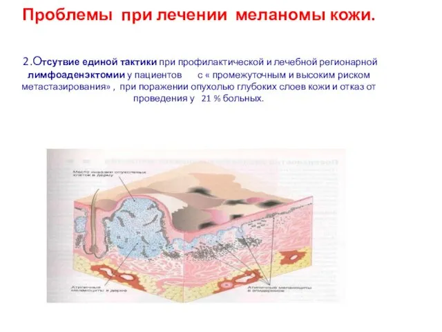 Проблемы при лечении меланомы кожи. 2.Отсутвие единой тактики при профилактической и