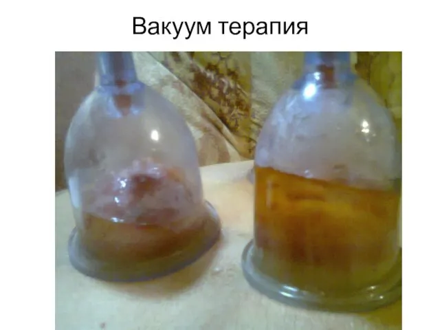 Вакуум терапия