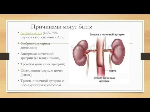 Причинами могут быть: Атеросклероз (в 65-75% случаев вазоренальных АГ); Фибромускулярная дисплазия;