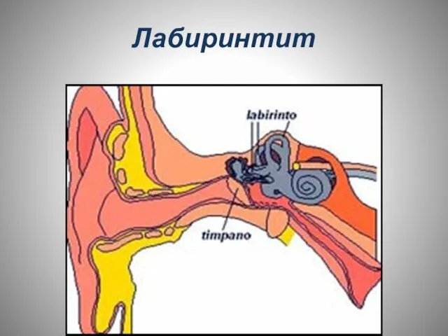 Лабиринтит