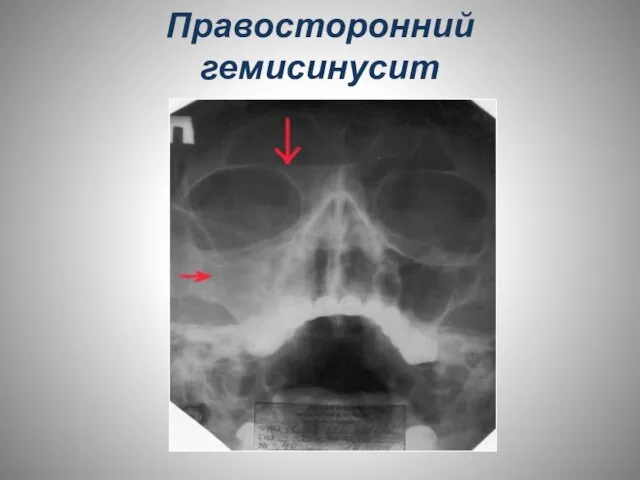 Правосторонний гемисинусит