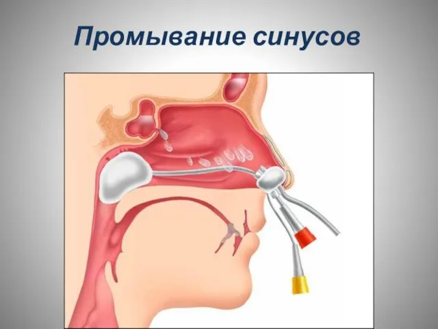 Промывание синусов