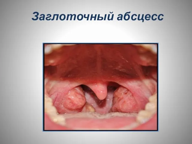 Заглоточный абсцесс