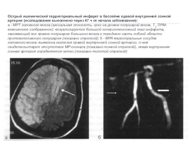Острый ишемический территориальный инфаркт в бассейне правой внутренней сонной артерии (исследование