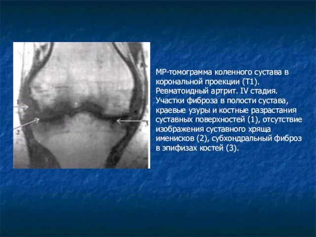 МР-томограмма коленного сустава в корональной проекции (Т1). Ревматоидный артрит. IV стадия.