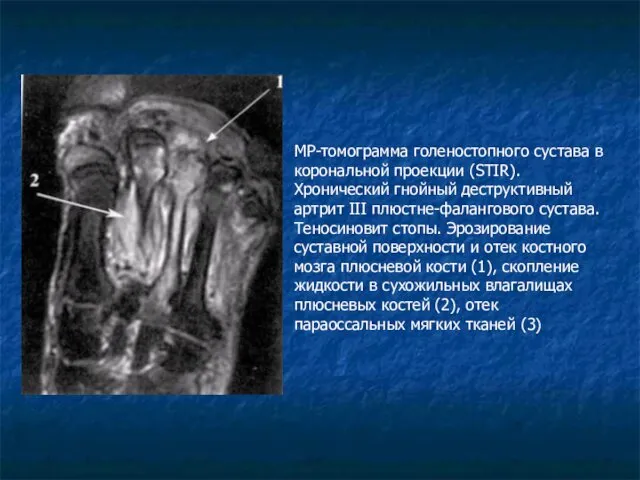 МР-томограмма голеностопного сустава в корональной проекции (STIR). Хронический гнойный деструктивный артрит