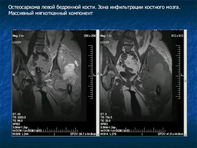 Остеосаркома левой бедренной кости. Зона инфильтрации костного мозга. Массивный мягкотканный компонент