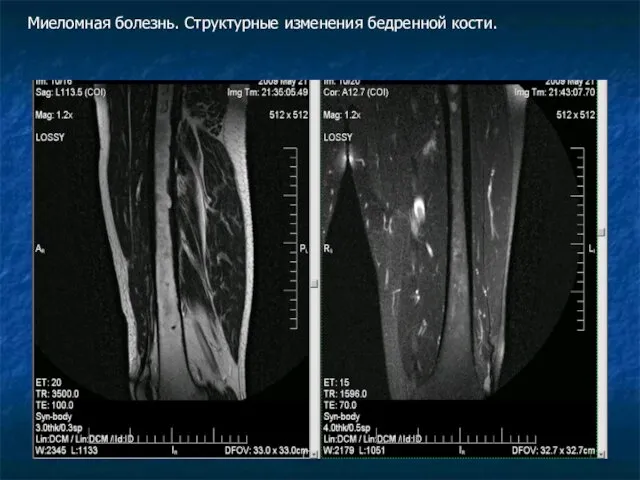 Миеломная болезнь. Структурные изменения бедренной кости.