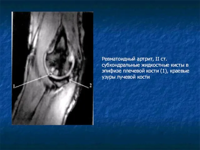 Ревматоидный артрит, II ст. субхондральные жидкостные кисты в эпифизе плечевой кости (1), краевые узуры лучевой кости