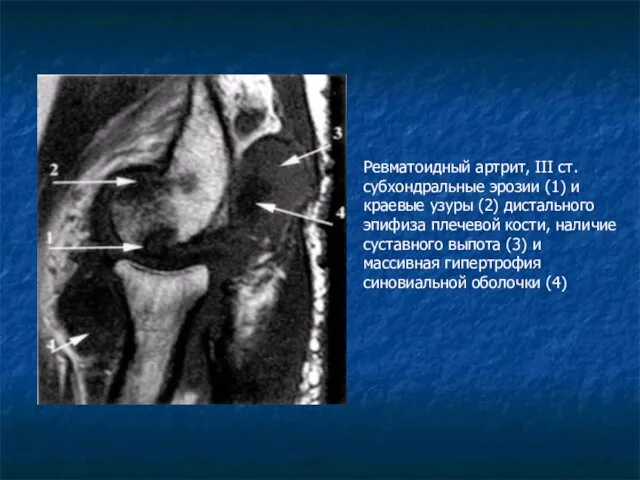 Ревматоидный артрит, III ст. субхондральные эрозии (1) и краевые узуры (2)