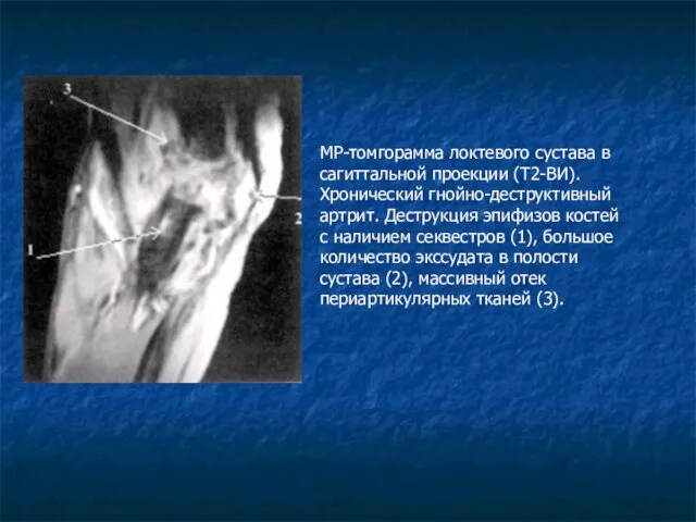 МР-томгорамма локтевого сустава в сагиттальной проекции (Т2-ВИ). Хронический гнойно-деструктивный артрит. Деструкция