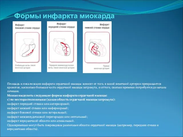 Формы инфаркта миокарда Площадь и локализация инфаркта сердечной мышцы зависят от