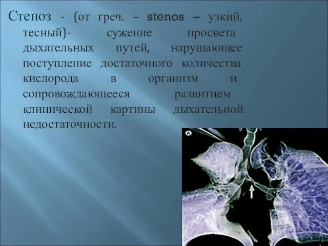 Стеноз - (от греч. – stenos – узкий, тесный)- сужение просвета